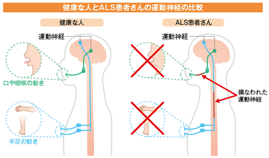 健康な人とALS患者さんの運動神経の比較