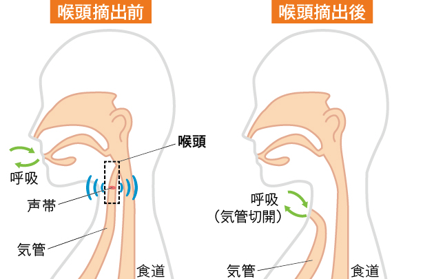 喉頭摘出術