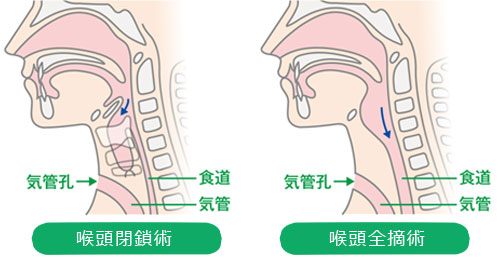 図4：誤嚥防止術